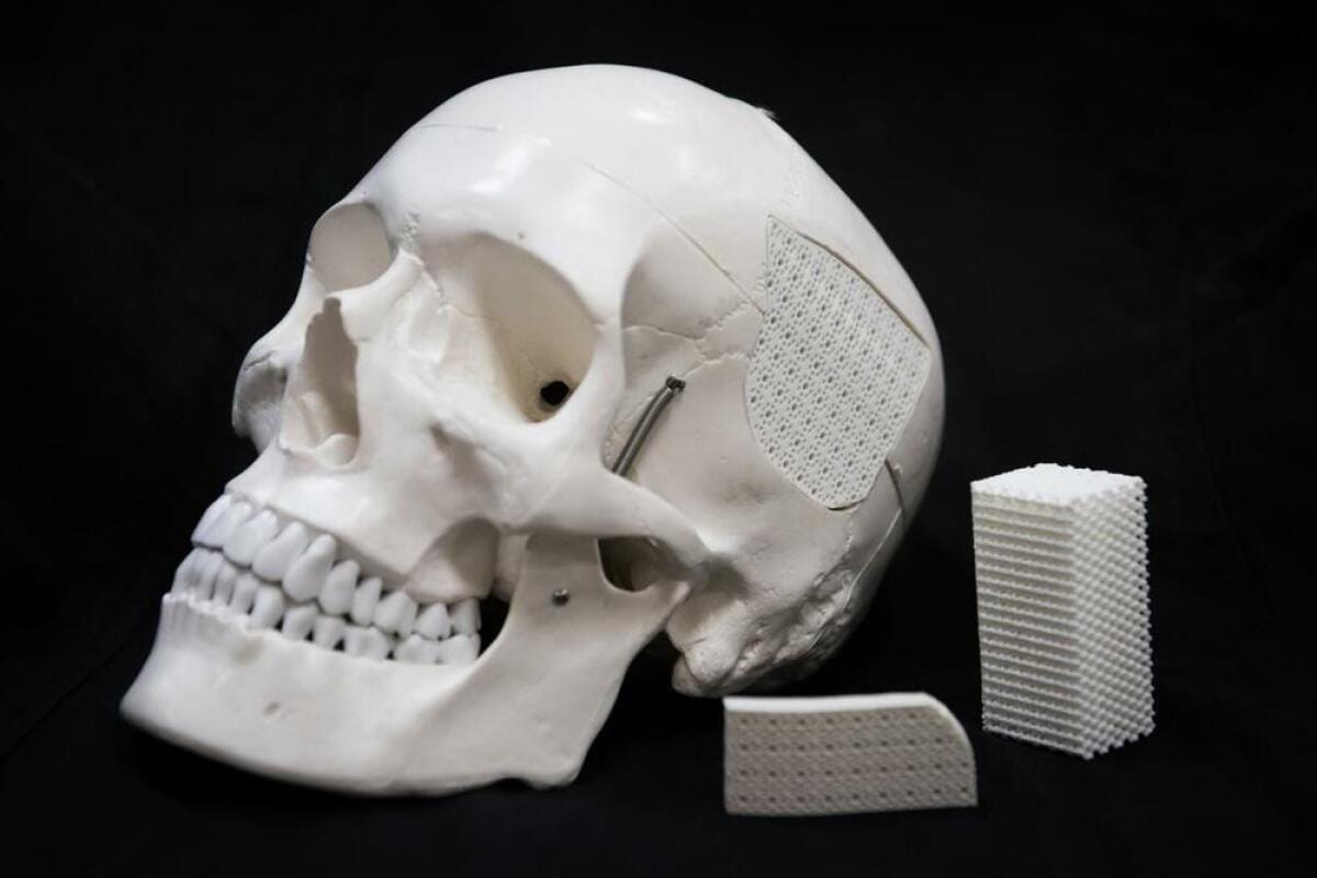 3D-printede bein: En revolusjon i medisinsk teknologi