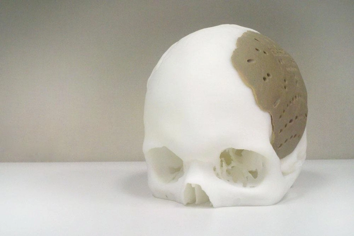 3D-printede bein: En revolusjon i medisinsk teknologi